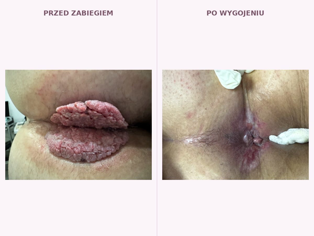 Zdjęcie medyczne — kłykciny olbrzymie przed zabiegiem i okolica po wygojeniu